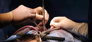 The Sternum Is Not Cut In Closed Bypass Surgery.
