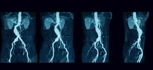 Aort Anevrizmasında Tanı Nasıl Konur