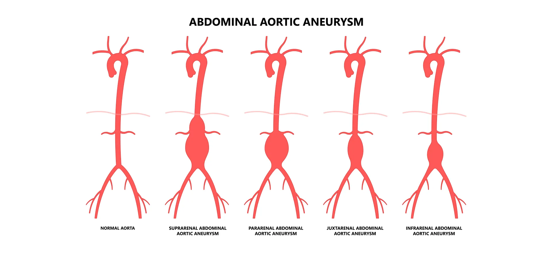 Karın Aort Damar Anevrizmalarında Anjiyo ile Stent Yerleştirme Mümkün mü?