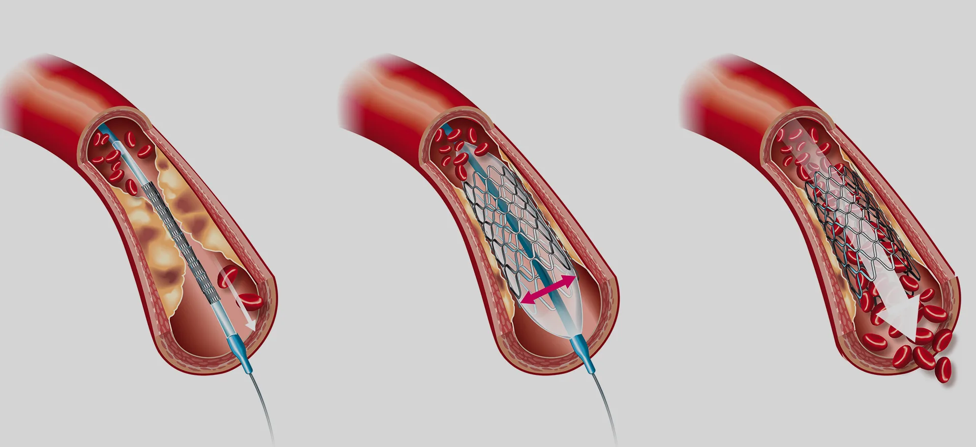 Does Stent Placement Prevent Bypass Surgery?