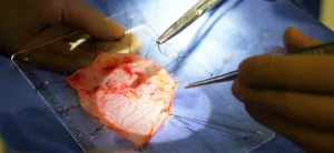 Ozaki Prosedürü Dünyada Ve Türkiye’de Kaç Yıldır Yapılmaktadır?