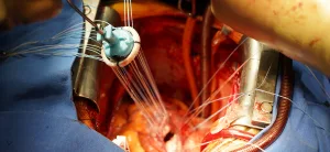 Koltuk Altı (Minimal İnvaziv) Mitral Kapak Değişiminin Avantajları Nelerdir?