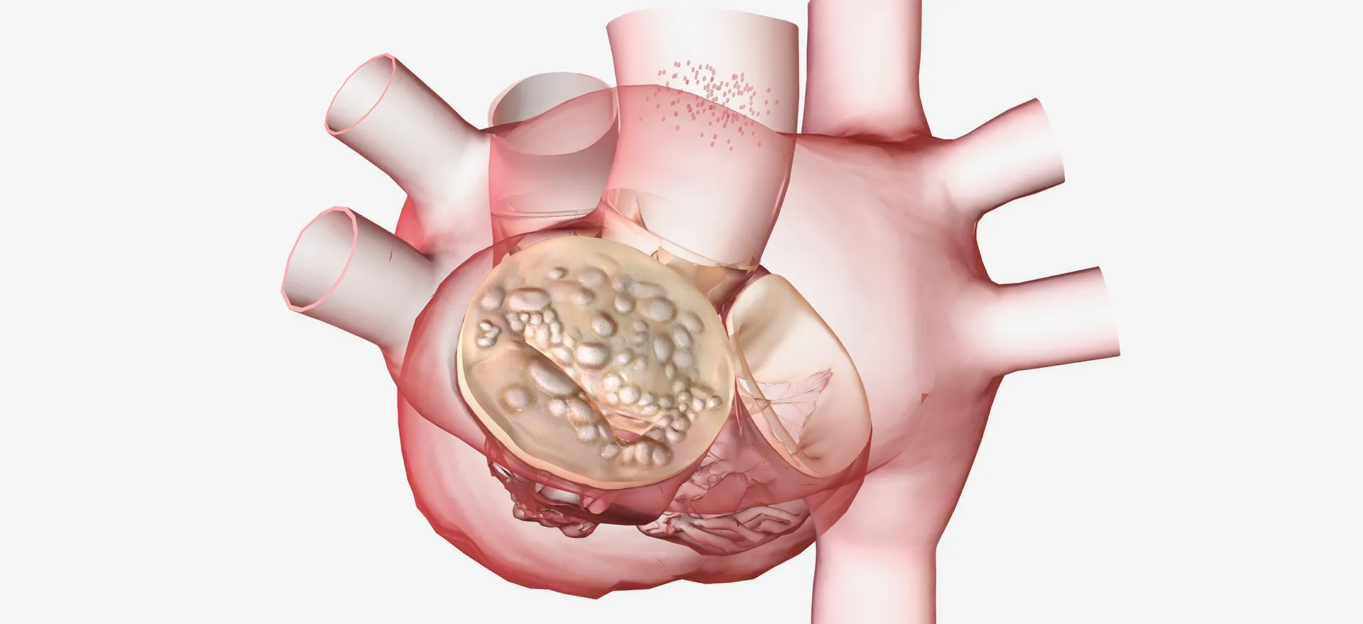 Mitral Darlığı Nedir? Belirtileri Ve Nedenleri Nelerdir?