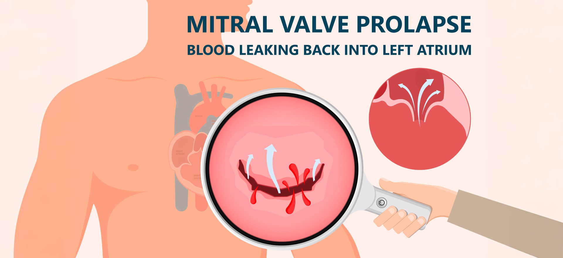 Mitral-Yetmezliği-Nedir-Nedenleri-Nelerdir-Hangi-Şikayetlere-Sebep-Olur