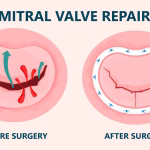 Mitral Yetmezliğinde Tedavi Nasıldır Ve Ne Tür Ameliyatlar Yapılır?